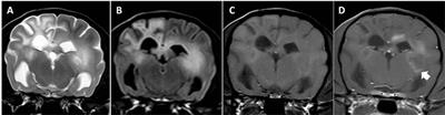 Breed-Specific Magnetic Resonance Imaging Characteristics of Necrotizing Encephalitis in Dogs